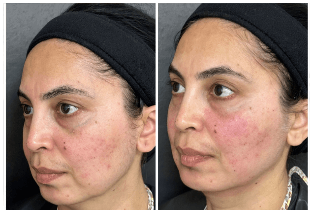 Dermal Fillers in Lucknow